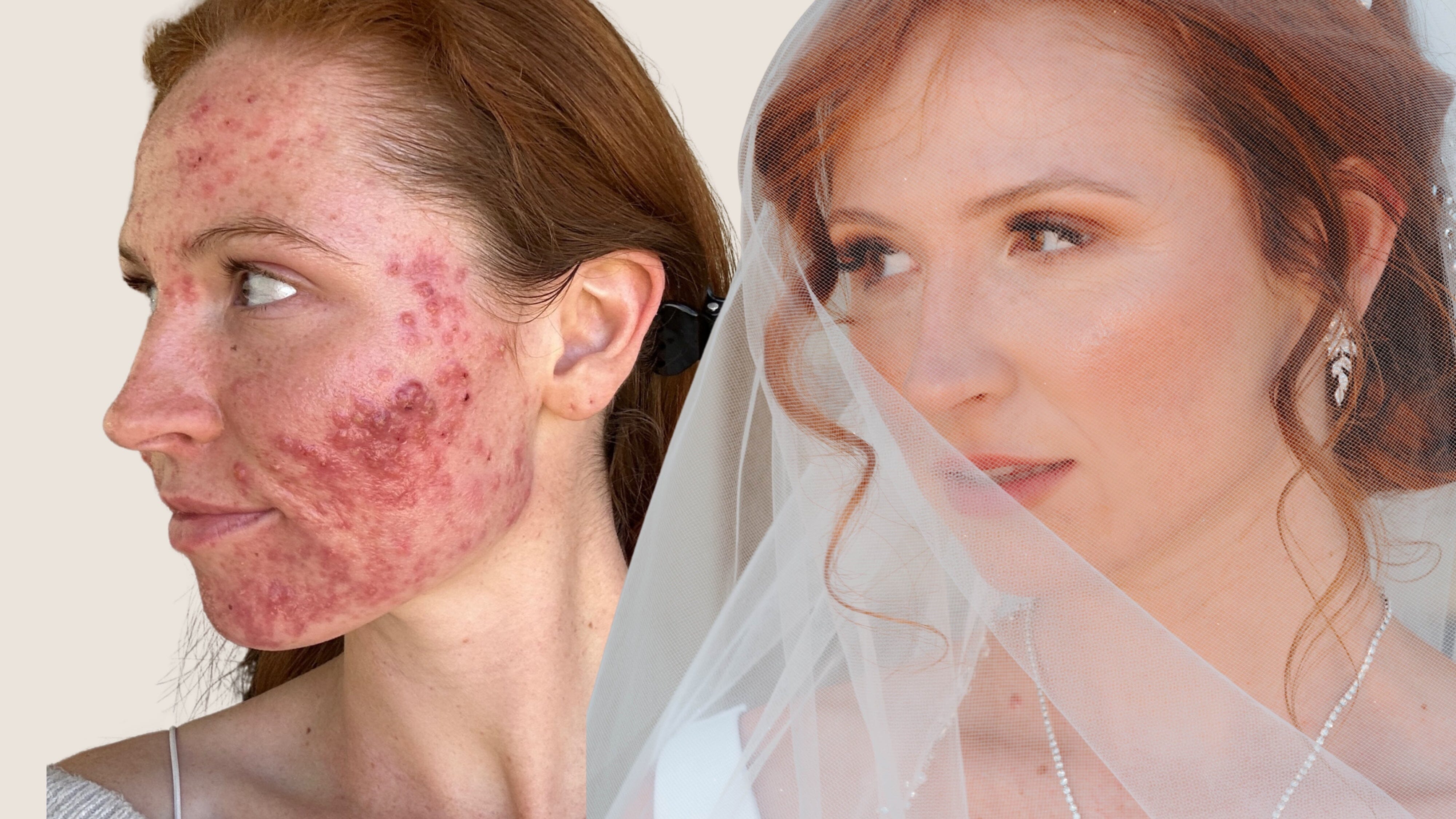 Grace’s Personalized Holistic Acne Treatment: What Finally Worked (+ Why it Was Worth the Wait)