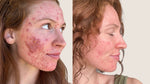 How I Healed Years of Chronic Acne + Constant Breakouts: A Personal Story From Grace