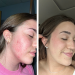 Brooklyn Skin Before and After